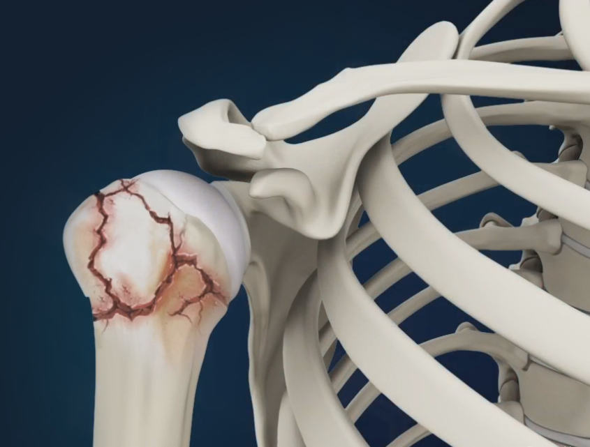 shoulder fracture treatment in nagpur
